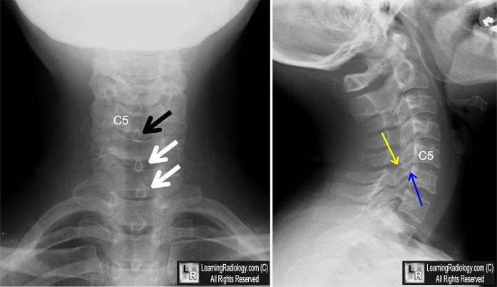 unilateral locked facet